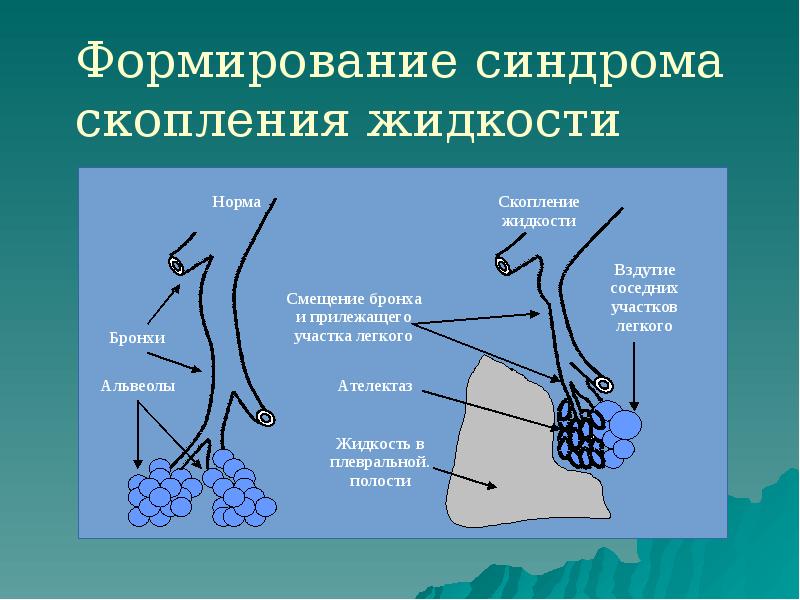 Формирование синдрома скопления жидкости Формирование синдрома скопления жидкости