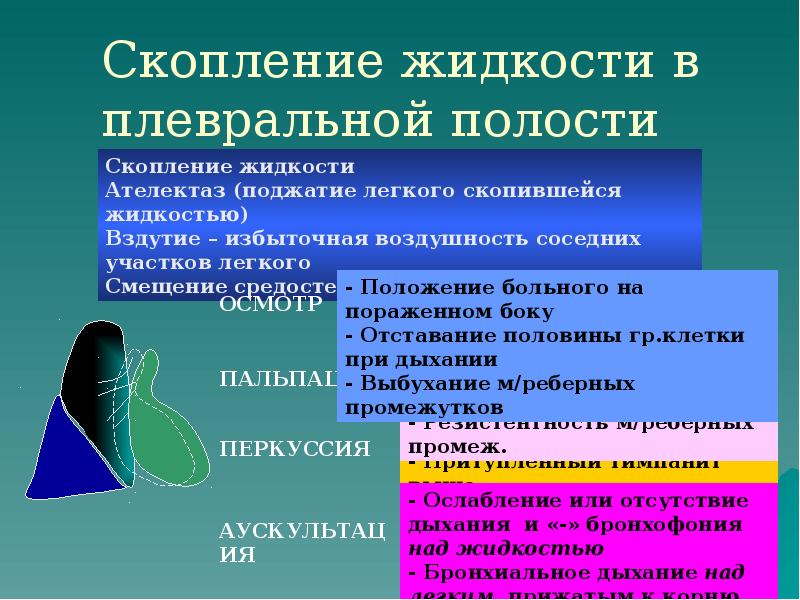 Скопление жидкости в плевральной полости Скопление жидкости в плевральной полости