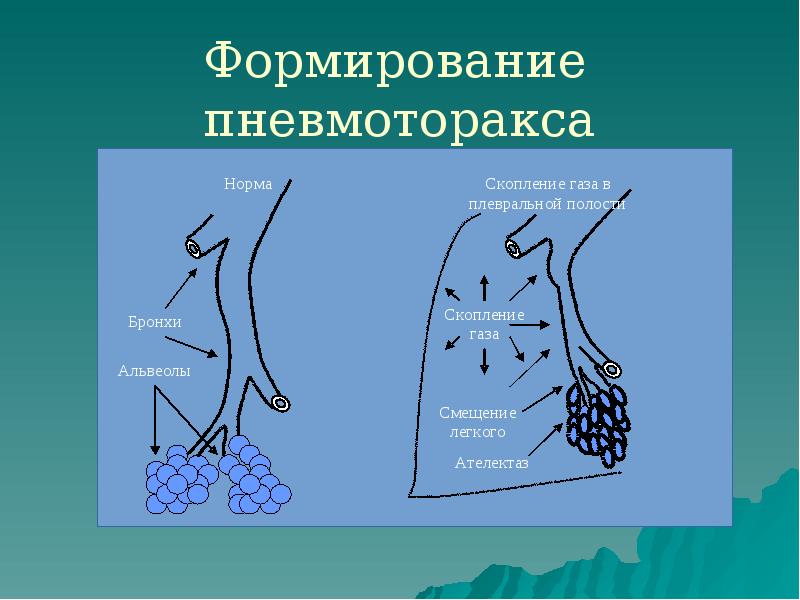 Формирование пневмоторакса Формирование пневмоторакса