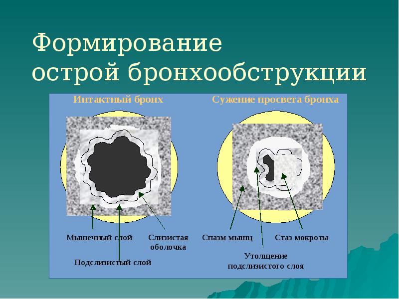 Формирование острой бронхообструкции Формирование острой бронхообструкции