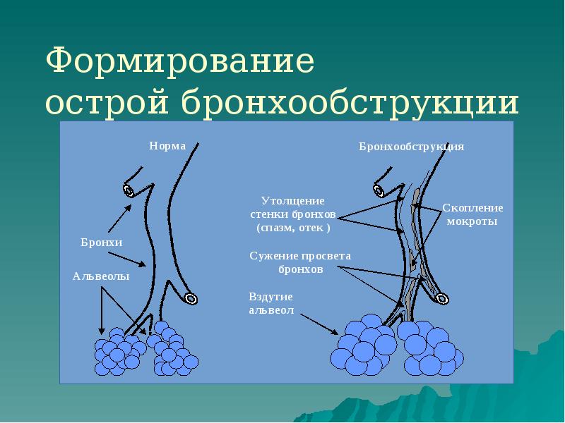 Формирование острой бронхообструкции Формирование острой бронхообструкции