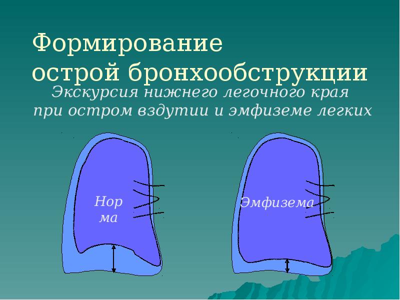 Формирование острой бронхообструкции Формирование острой бронхообструкции