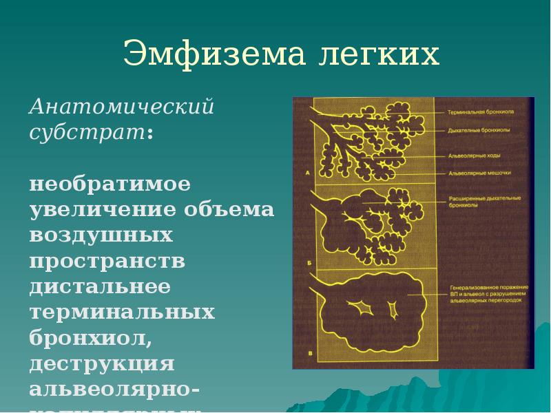 Эмфизема легких Эмфизема легких