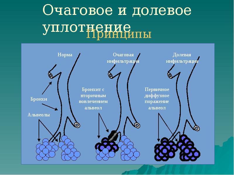 Очаговое и долевое уплотнение Очаговое и долевое уплотнение