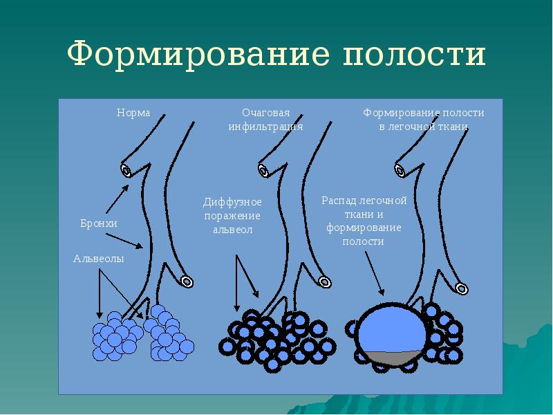 Формирование полости Формирование полости