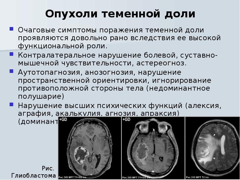 Проявления поражения теменной доли.. Объемное образование головного мозга. Глиальная опухоль головного