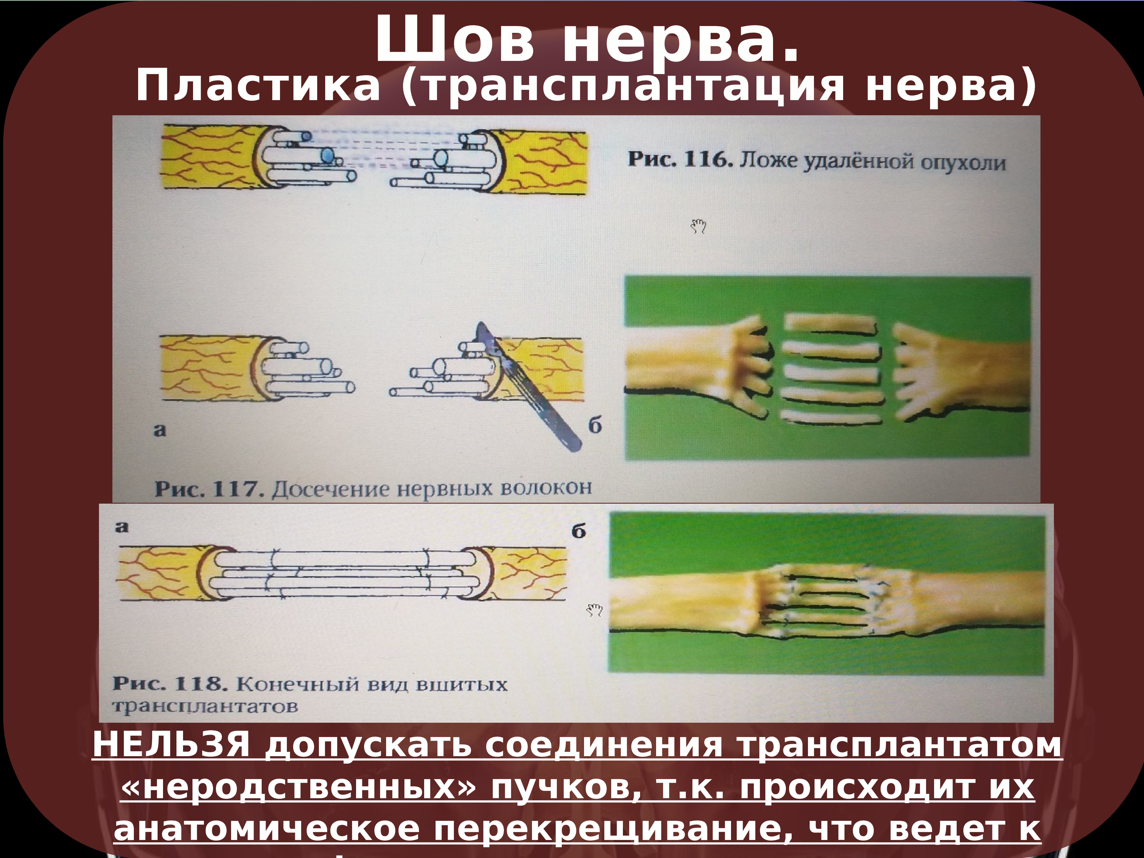 Шов нерва презентация