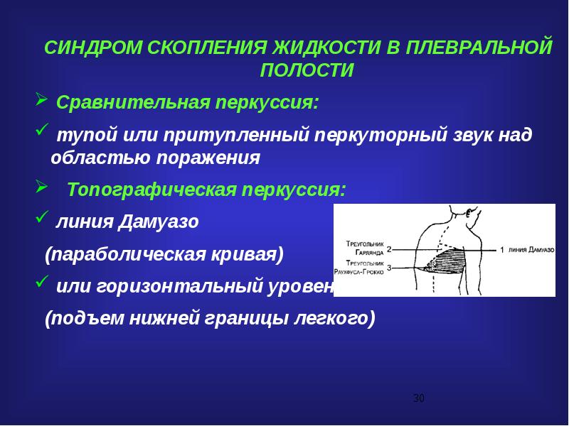 Синдром скопления жидкости. Жидкость в плевральной полости. Горизонтальный уровень жидкости в плевральной полости. Скопление жидкости в плевральной полости. Синдром скопления жидкости в плевральной полости.