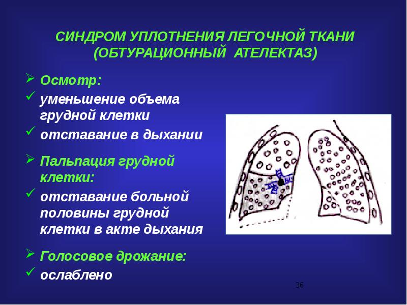 Уплотнение легочной ткани. Синдром уплотнения легочной ткани рентген. Очаговое воспалительное уплотнение легочной ткани. Синдром уплотнения легочной ткани клинические проявления. Долевое уплотнение легочной ткани рентген.