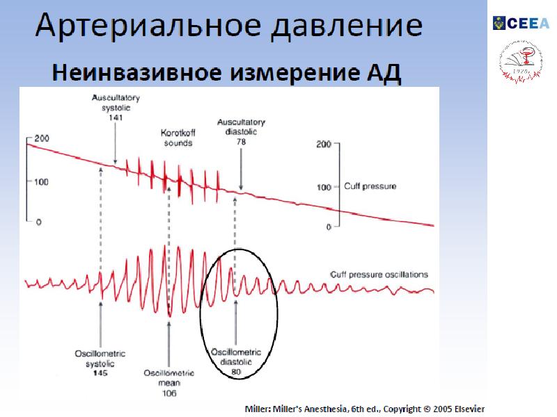 Мониторинг во. Повышаетсч ди давление во время наркоза.