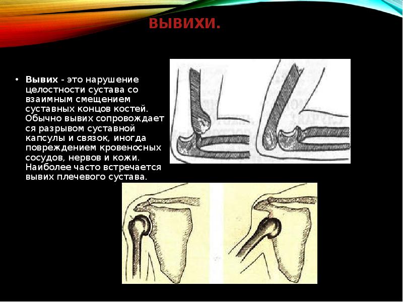 Вывих это. Что такое вывих нарушение целостности. Нарушение целостности суставной капсулы. Смещение суставных поверхностей костей сопровождающееся нарушением.