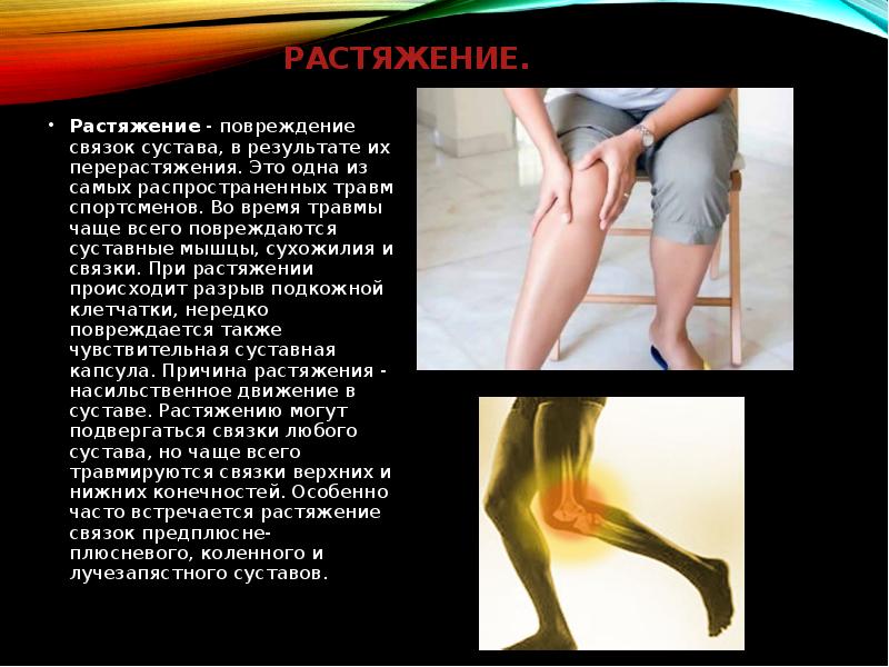 Растяжение. Растяжение - повреждение связок сустава, в результате их перерастяжения. Это