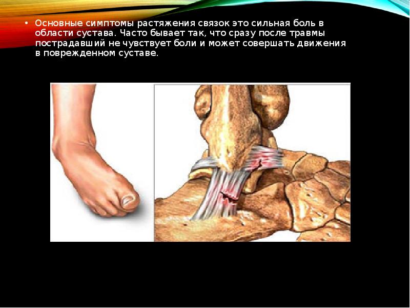 Основные симптомы растяжения связок это сильная боль в области сустава. Часто