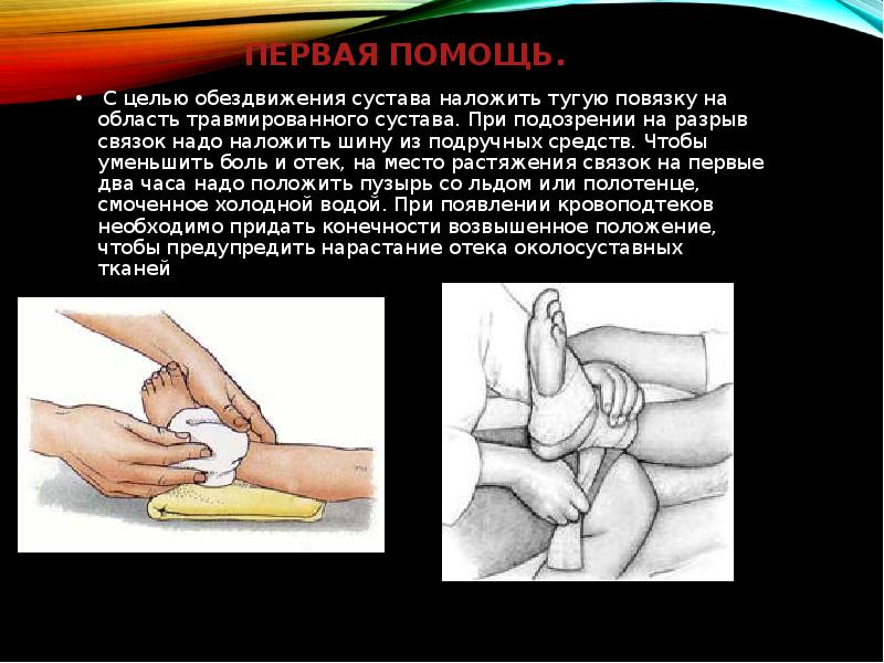 Первая помощь. &nbsp;С целью обездвижения сустава наложить тугую повязку на область