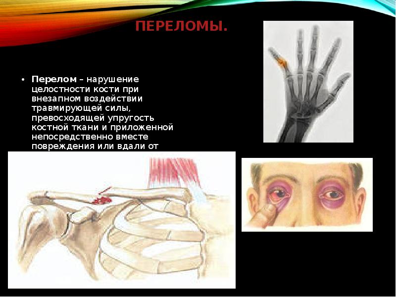 Переломы. Перелом – нарушение целостности кости при внезапном воздействии травмирующей силы,