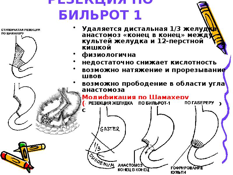 Резекция желудка по бальфуру схема