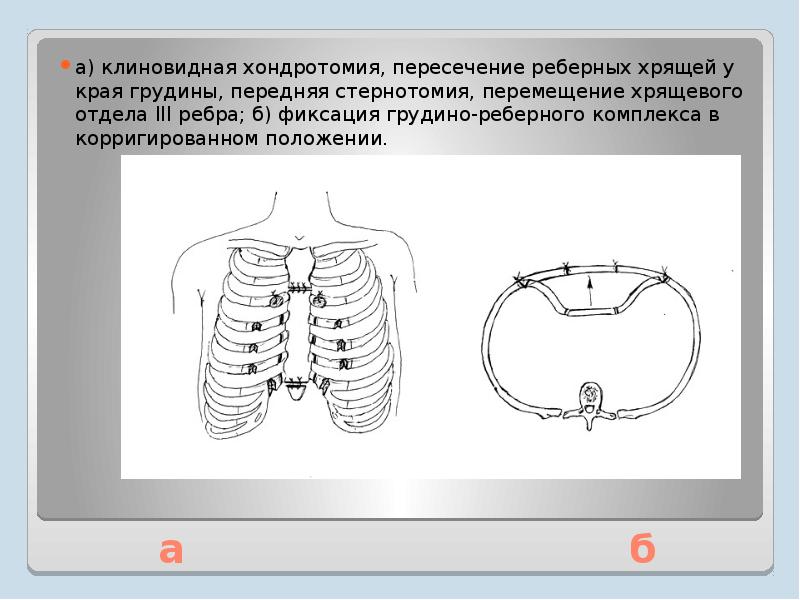пластина насса при воронкообразной деформации грудной клетки. протрузия реберных дуг корсет. степени деформации грудной клетки. врожденная расщелина грудины. воронкообразная и килевидная деформация грудной клетки операция.