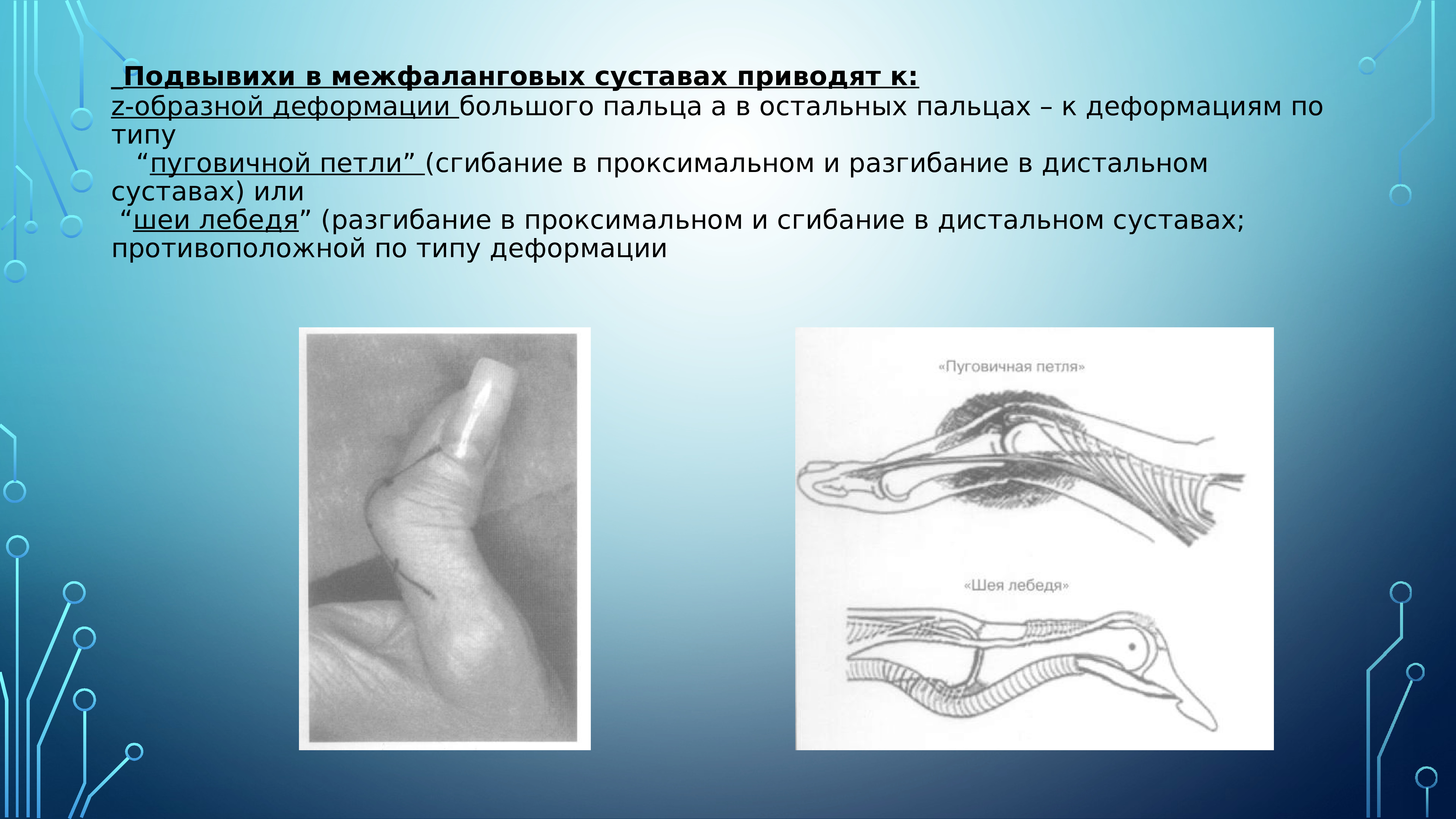 Межфаланговые суставы. Дистальные межфаланговые суставы. Межфаланговый сустав большого пальца. Деформация межфаланговых суставов по типу «пуговичной петли».. Деформация межфаланговых суставов.