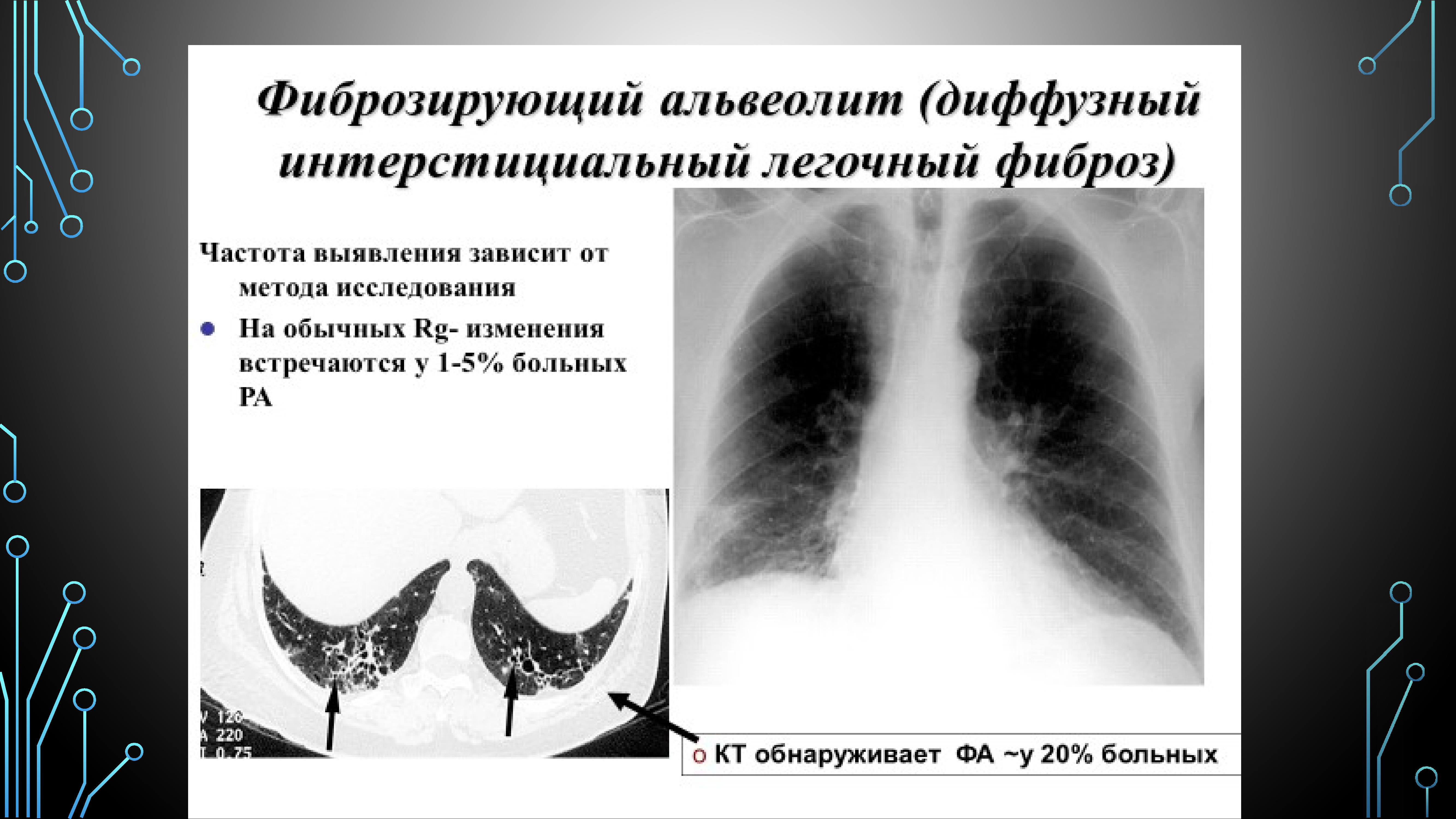 Презентация идиопатический фиброзирующий альвеолит