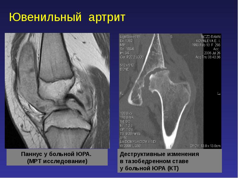 Ювенильный идиопатический артрит презентация