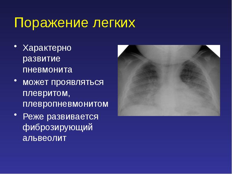 Альвеолит у детей презентация