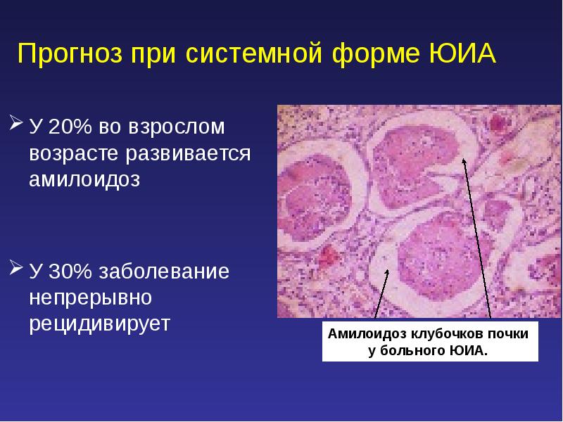 Ювенильный идиопатический артрит презентация