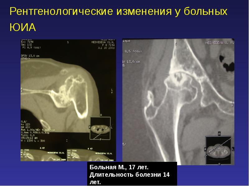 Ювенильный идиопатический артрит презентация