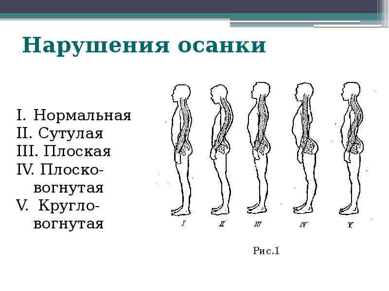 Как называется нарушение осанки изображенное на рисунке 3