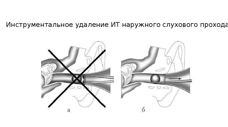 Инородные тела презентация