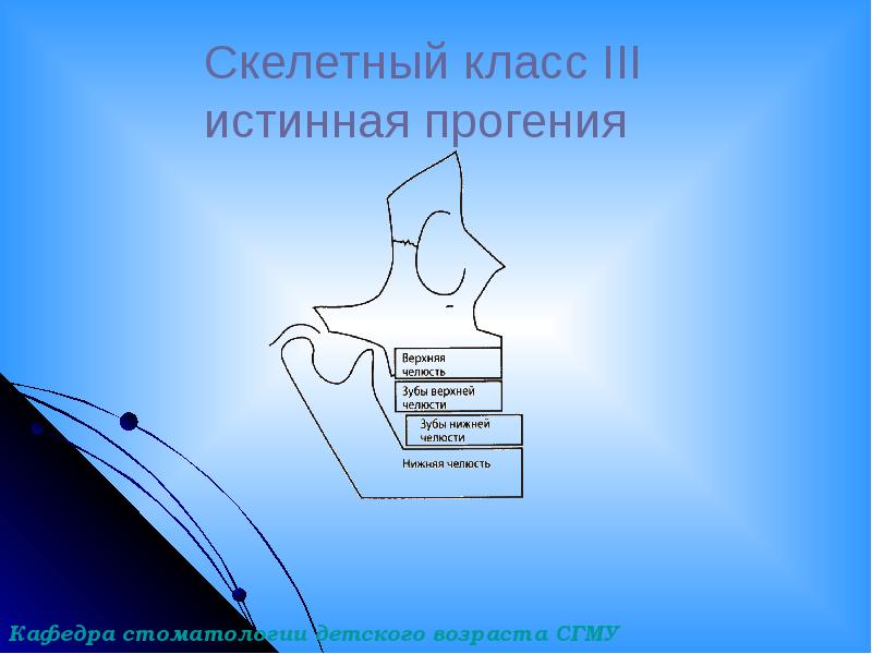 Скелетный класс III истинная прогения Скелетный класс III истинная прогения