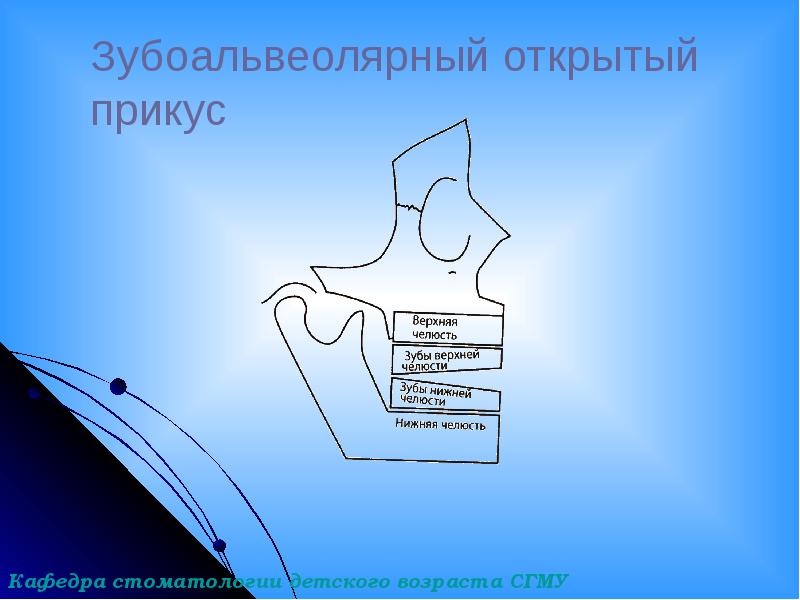 Зубоальвеолярный открытый прикус Зубоальвеолярный открытый прикус