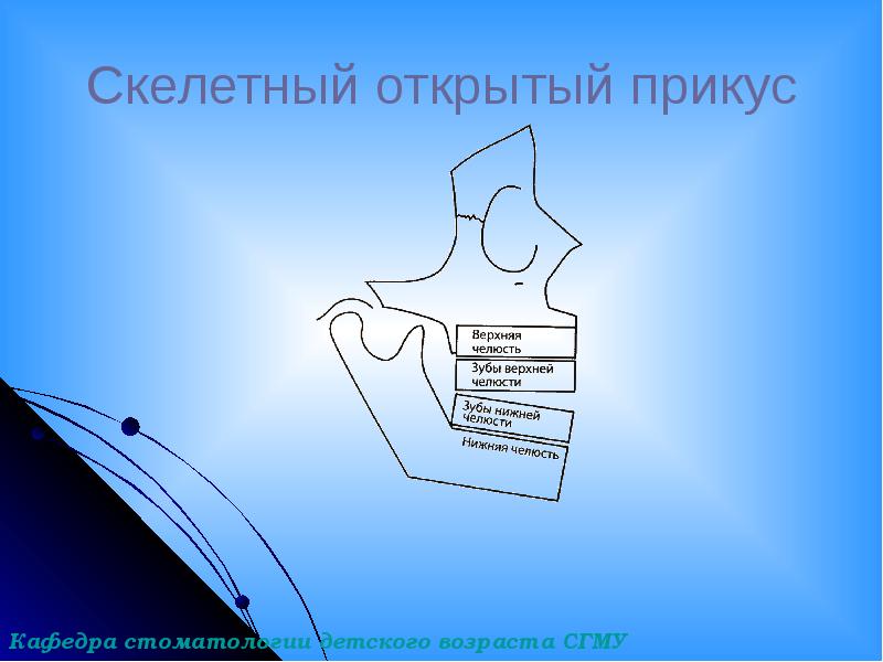 Скелетный открытый прикус Скелетный открытый прикус