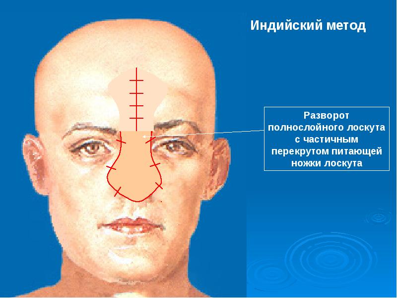 Схема индийского способа кожной пластики