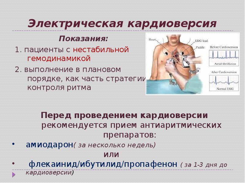 После кардиоверсии