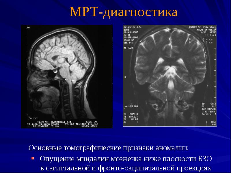 Мр картина низкого расположения миндалин мозжечка