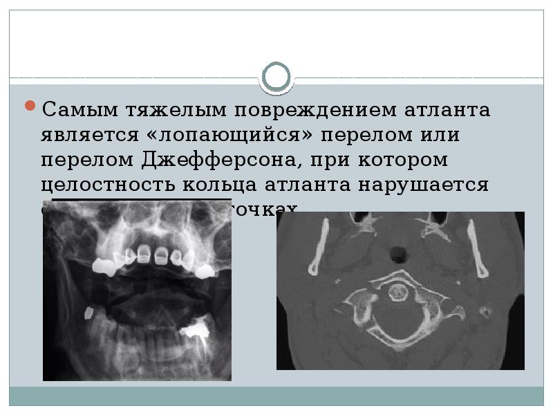 Перелом шейного отдела позвоночника презентация