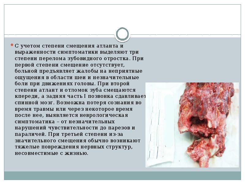 Перелом шейного отдела позвоночника презентация