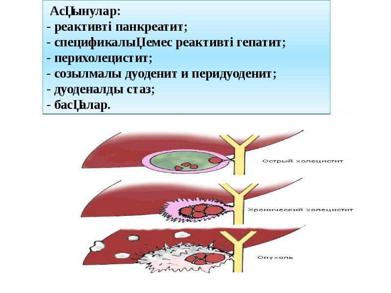 Созылмалы холецистит презентация