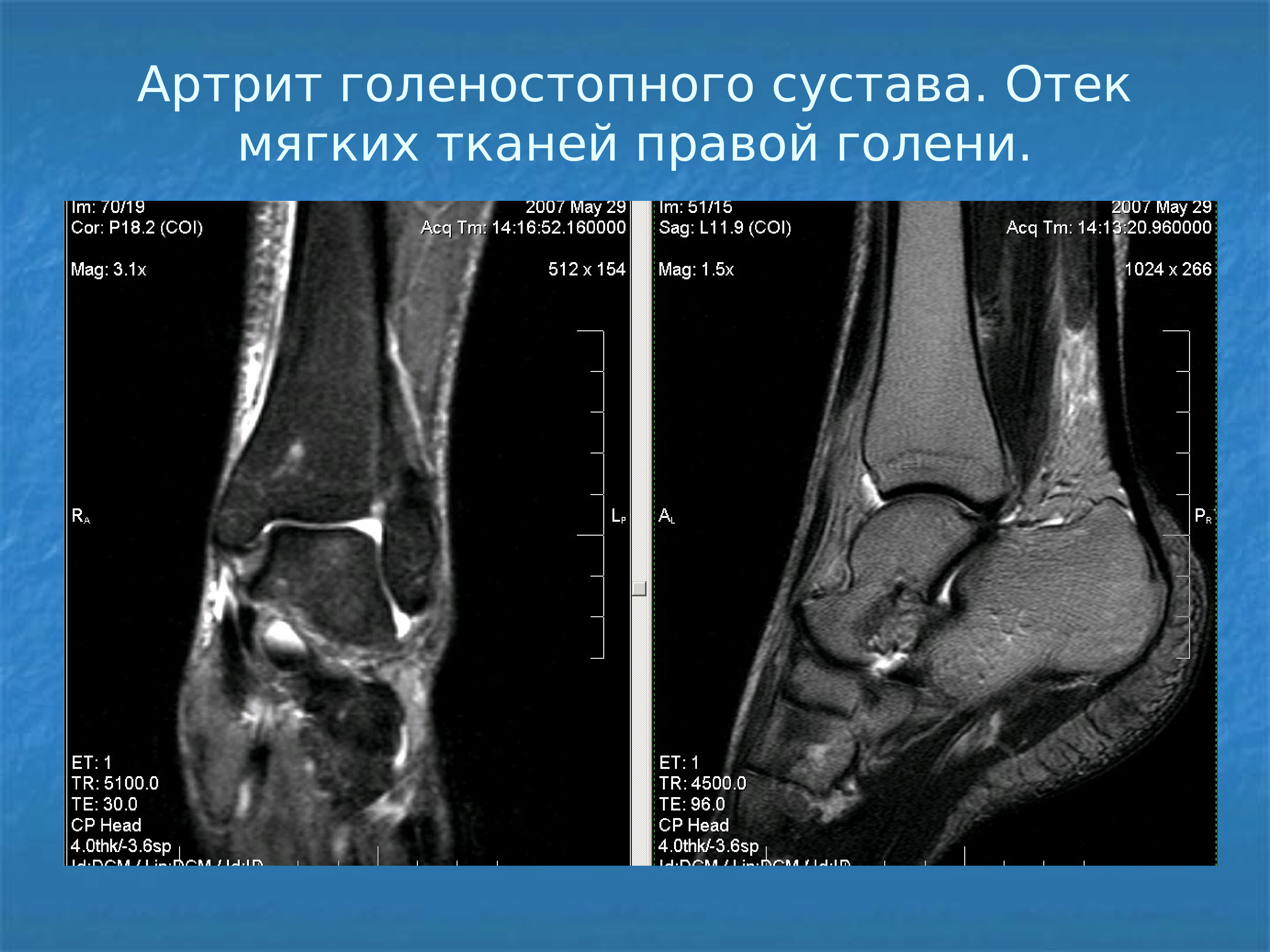 Образование мягких тканей. Артрит отек голеностопа. Артрит правого голеностопного сустава. Мягкие ткани голеностопного сустава. Опухоль голеностопного сустава.