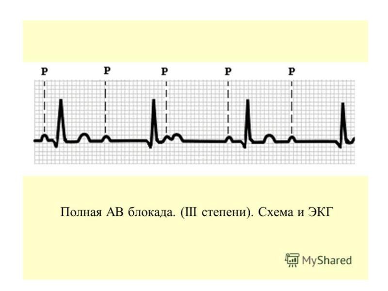 Полная блокада на экг