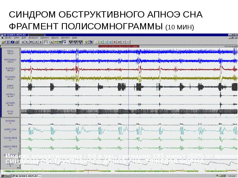 СИНДРОМ ОБСТРУКТИВНОГО АПНОЭ СНА ФРАГМЕНТ ПОЛИСОМНОГРАММЫ (10 МИН)