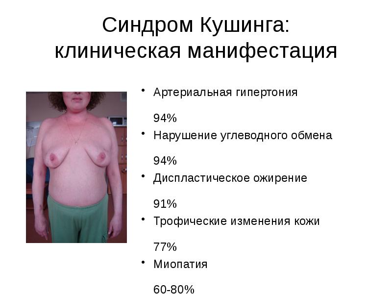 Синдром Кушинга: клиническая манифестация Артериальная гипертония 	94% Нарушение углеводного обмена	94% Диспластическое