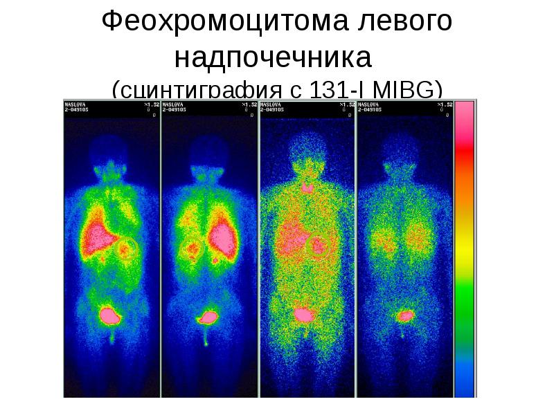 Феохромоцитома левого надпочечника  (сцинтиграфия с 131-I MIBG)