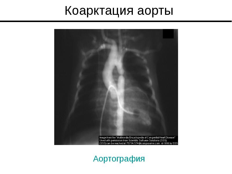 Коарктация аорты