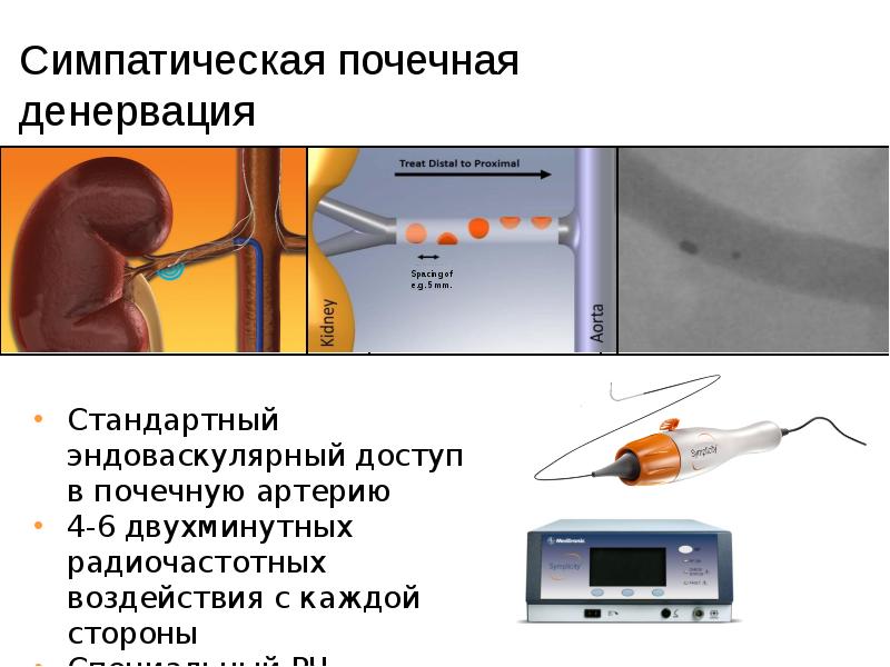 Симпатическая почечная денервация