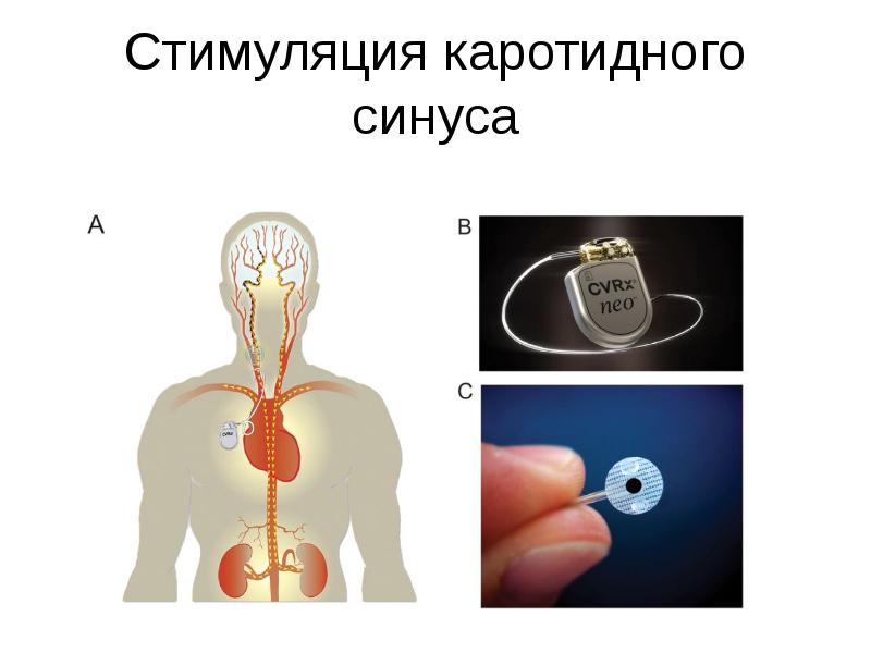 Стимуляция каротидного синуса
