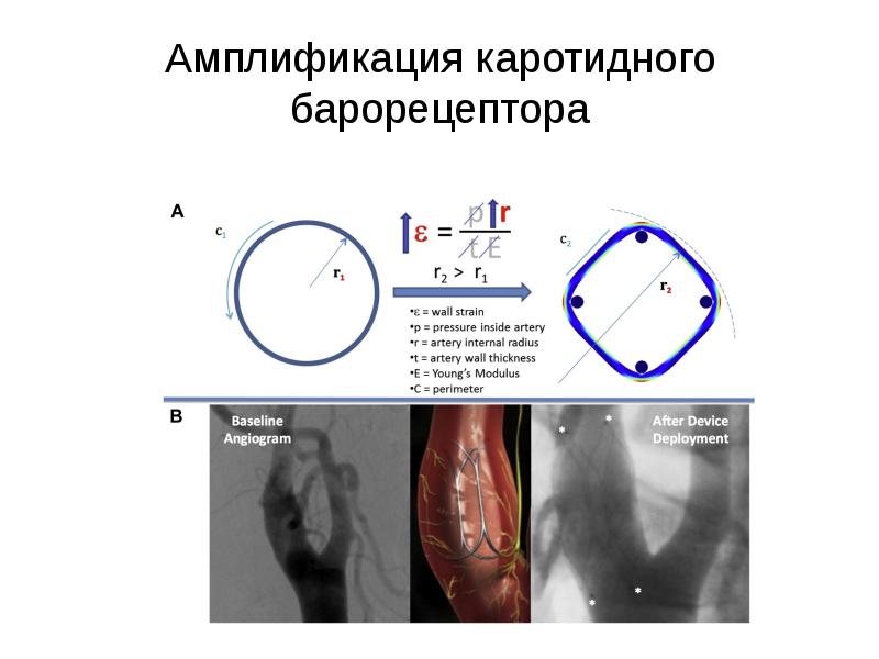 Амплификация каротидного барорецептора