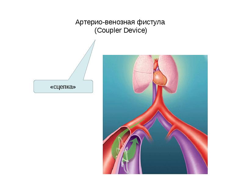 Артерио-венозная фистула  (Coupler Device)