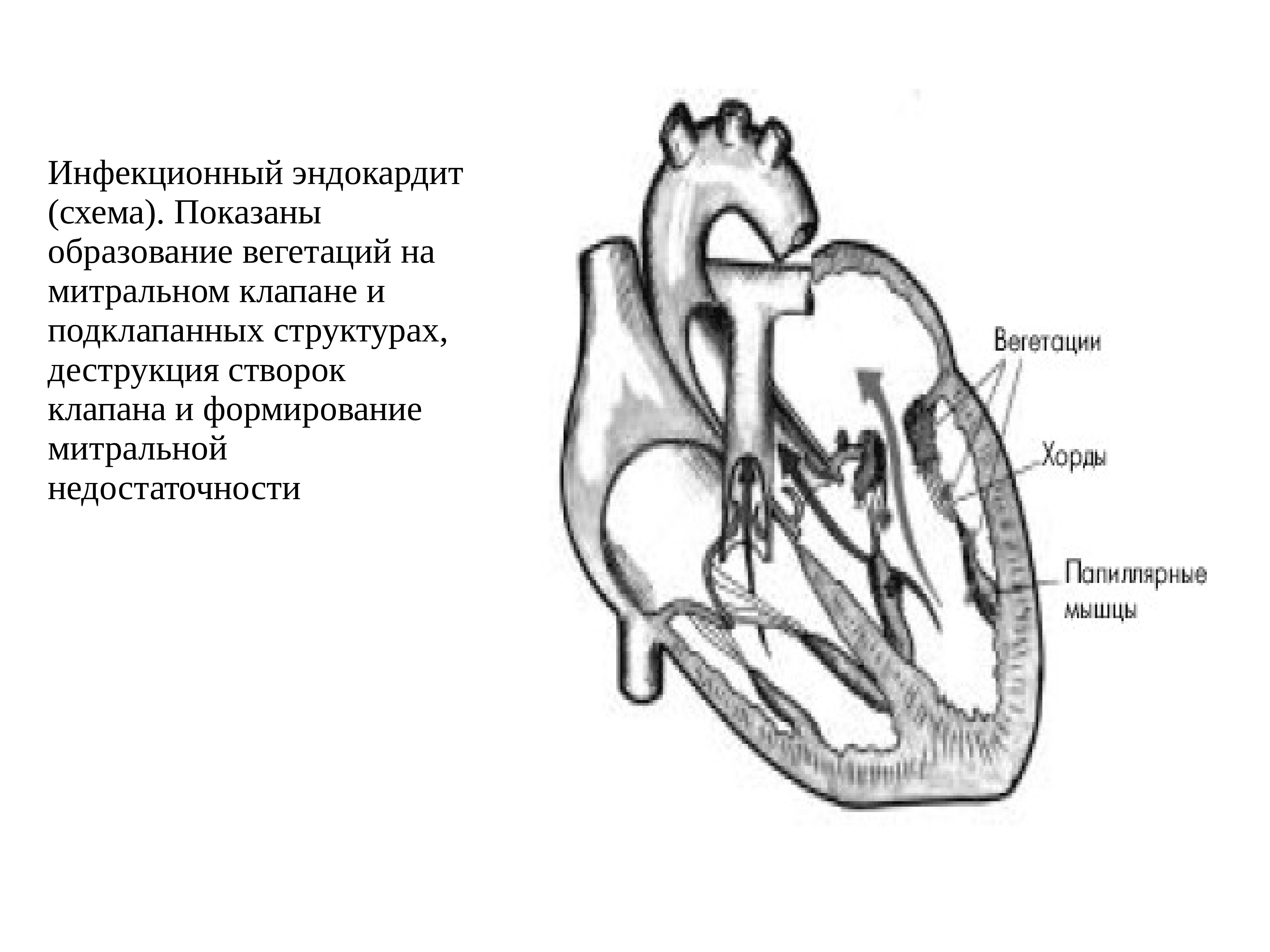 Эндокардит миокардит перикардит презентация