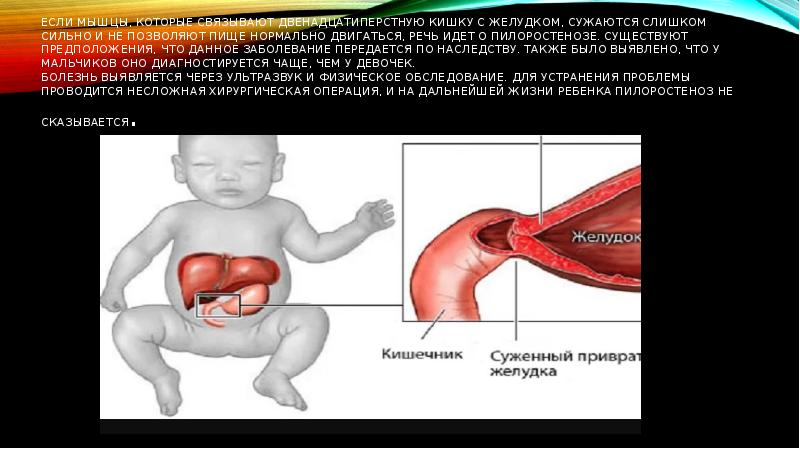 При пилоростенозе характерен стул